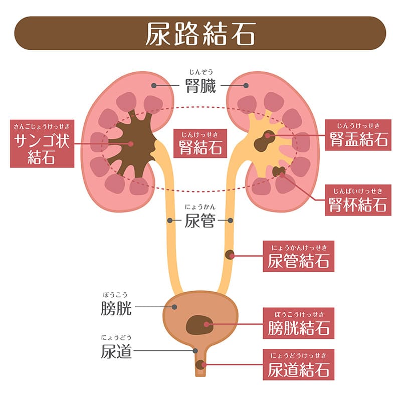 尿路結石とは